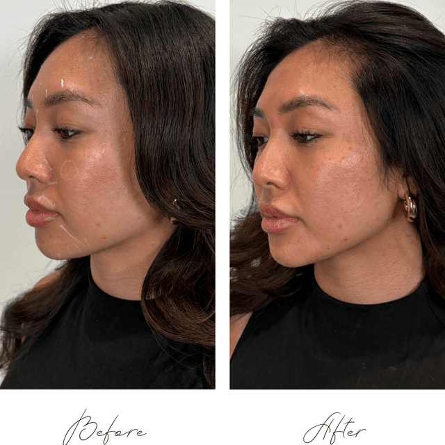 Upper Face Refresh at Atelier Aesthetics and Infusions in Dallas, TX